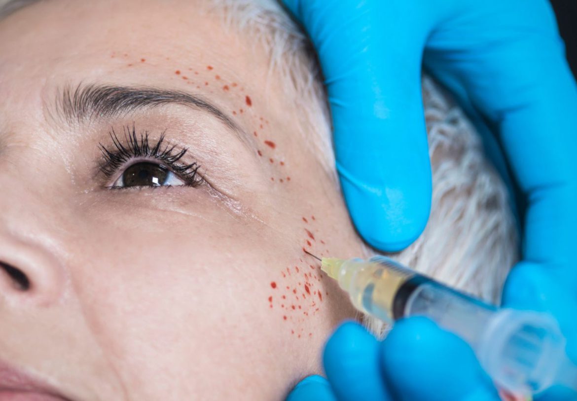 Revitalize Your Skin with The Benefits of Vampire Facial