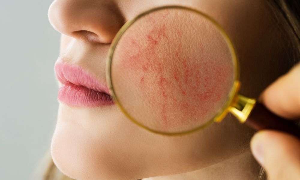 चेहरा लाल होना, बारीक फुन्सिया होना (Rosacea) क्या है? लक्षण, कारण और प्रभावी उपचार