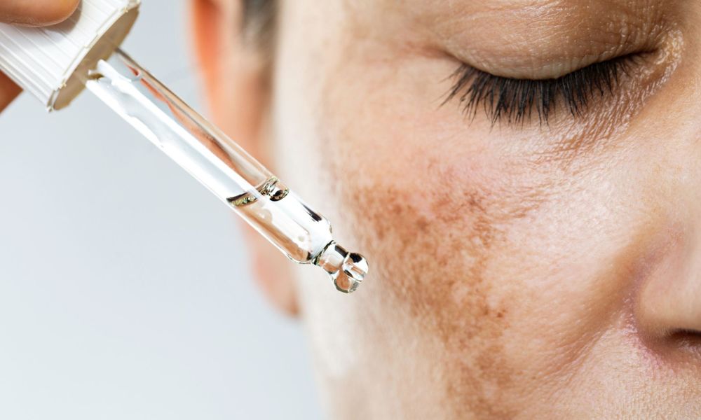 Hyperpigmentation: Causes, Types and Treatment Options