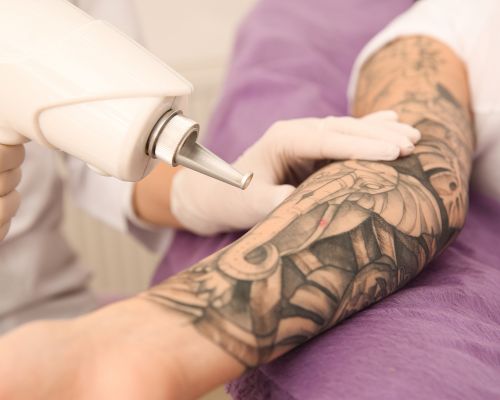 LASER Tattoo Removal in Udaipur - Arth Skin & Fitness