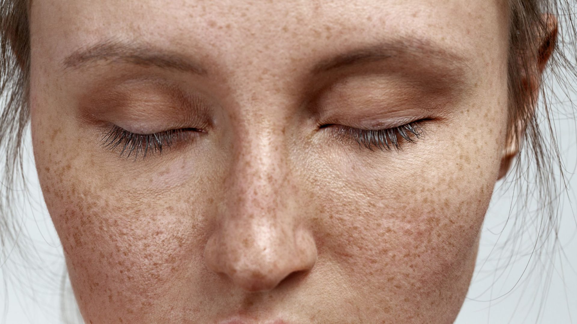 what-are-freckles-causes-types-treatment-options