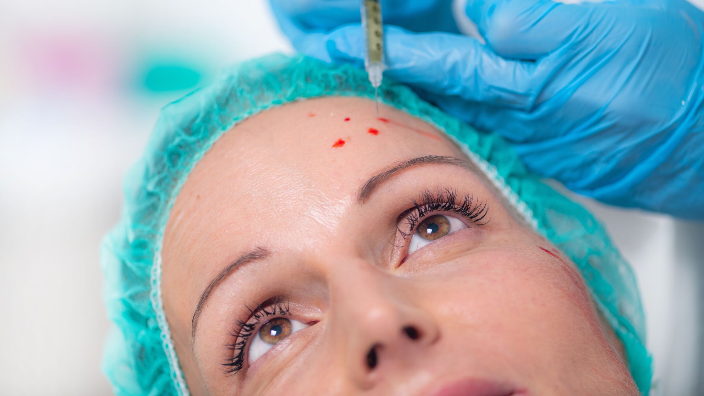 Effective Acne Scar Removal Treatments - Platelet-Rich Plasma (PRP)_ Boost Healing with Your Own Blood