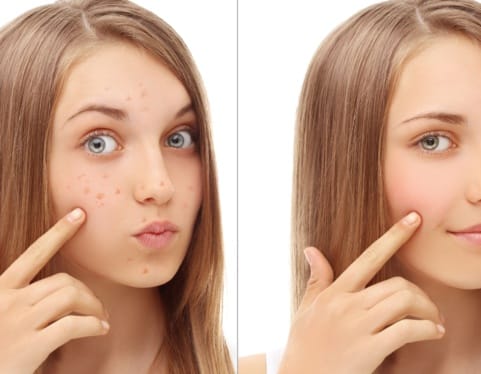 Safe and Effective Acne Scar Removal Treatments You Should Know