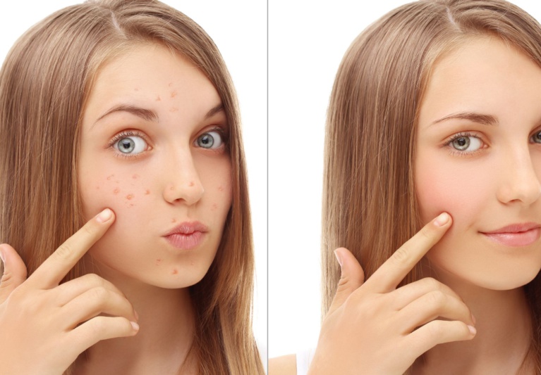 Safe and Effective Acne Scar Removal Treatments You Should Know