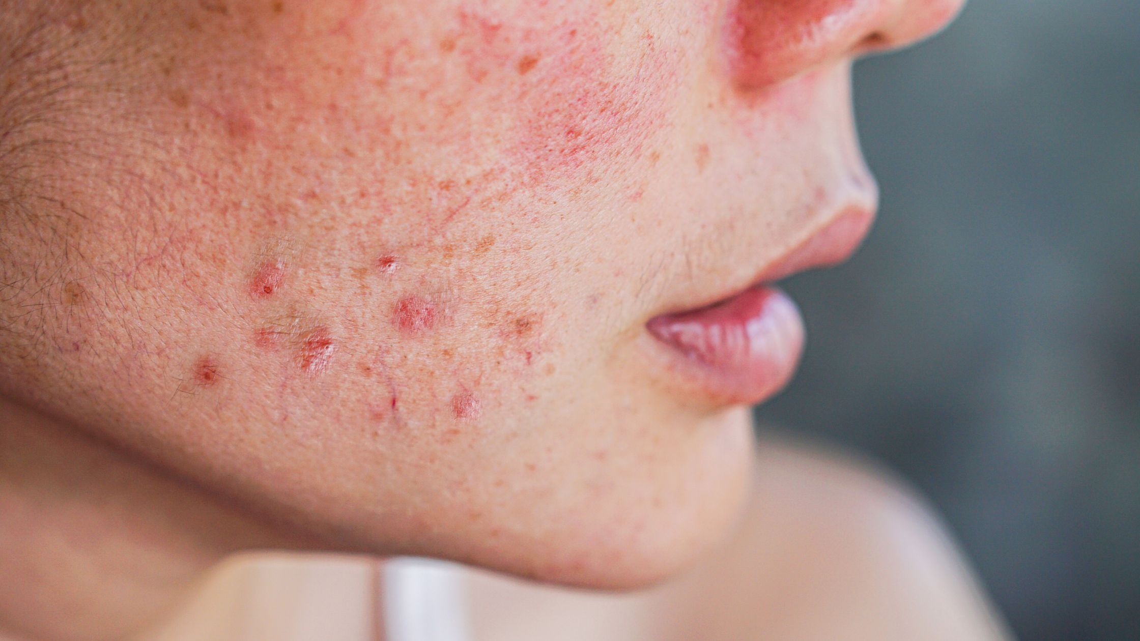 Effective Acne Scar Removal Treatments - Subcision_ Cutting Edge for Stubborn Scars