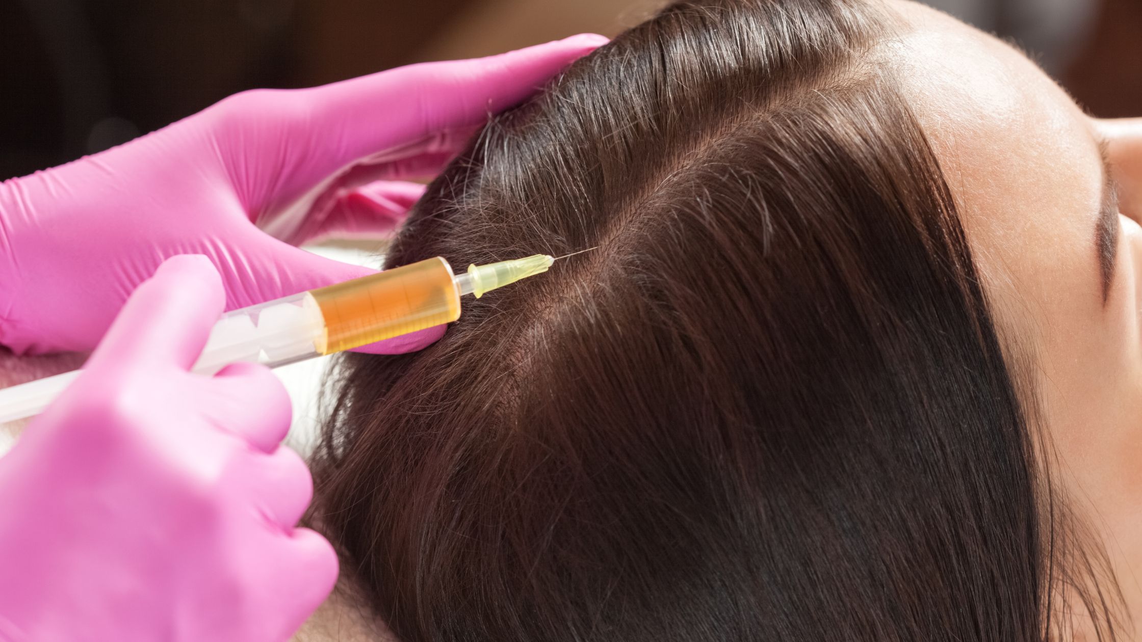 how hair prp therapy can transform your hair loss journey
