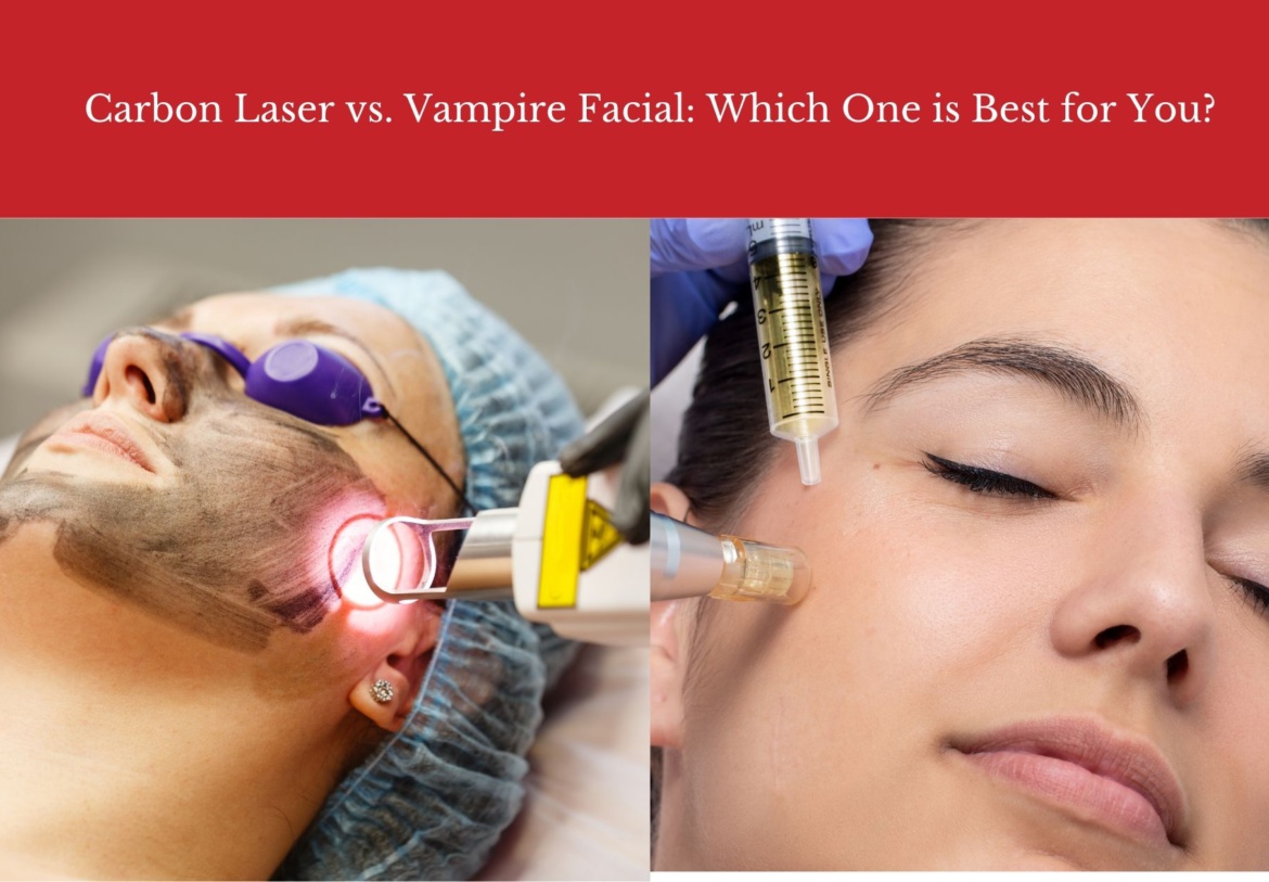 Carbon Laser vs. Vampire Facial: Which One is Best for You?