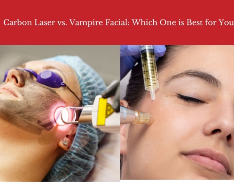 Carbon Laser vs. Vampire Facial: Which One is Best for You?