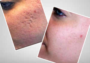 Scars and Acne Removal